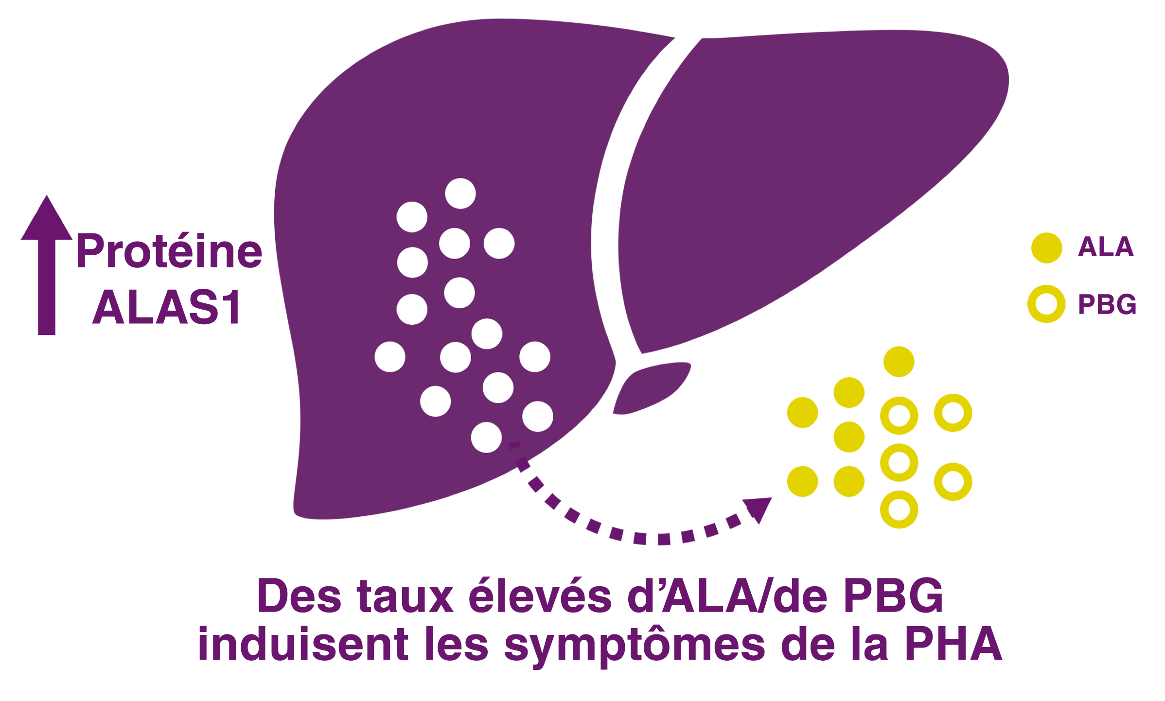 L’augmentation de l’activité d’ALAS1 entraîne l’accumulation neurotoxique d’ALA et de PBG